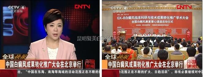 CCTV4报道：白癜风成果转化推广大会在北京举行