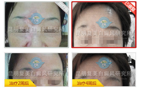 十大康复案例之二—女教师千里寻医 最终圆梦 十大康复案例之二—女教师千里寻医 最终圆梦
