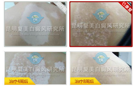十大康复案例之三—三年来首次回家过年,外出打工者 十大康复案例之三—三年来首次回家过年,外出打工者