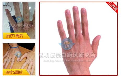 十大康复案例之四—青春发育期爆发白癜风,华厦拯救白斑少女 十大康复案例之四—青春发育期爆发白癜风,华厦拯救白斑少女