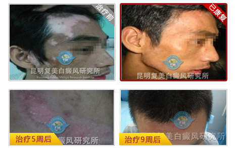 十大康复案例之六—小白斑不知不觉养三年,科研学者的白癜风治疗路 十大康复案例之六—小白斑不知不觉养三年,科研学者的白癜风治疗路