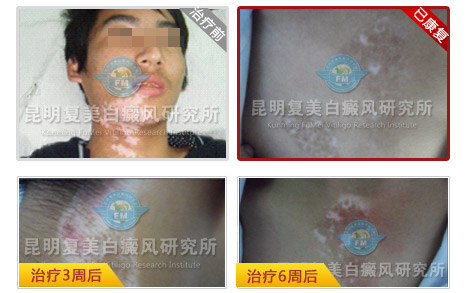 十大康复案例之七——设计师寻医三载,终找到治病良药 十大康复案例之七——设计师寻医三载,终找到治病良药